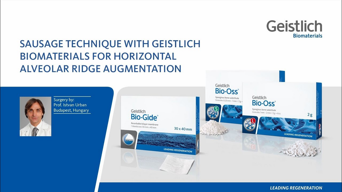 Sausage Technique with Geistlich Biomaterials for horizontal alveolar ridge Augmentation
